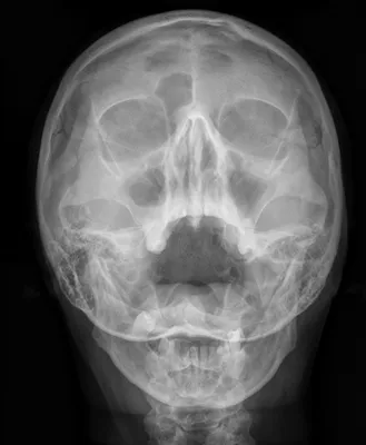 Рентген пазух носа – цена в Москве, сделать рентгенографию носовых пазух в  медицинском центре Медскан