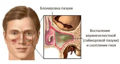 Хронический гиперпластический гаймороэтмоидит, нестойкая ремиссия.  Искривление перегородки носа у пациентки 36 лет