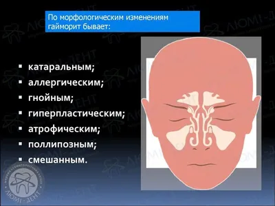 Что такое гайморит? Причины появления, симптомы и лечение