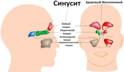 Синус-лифтинг при гайморите - SinusLifting.ru