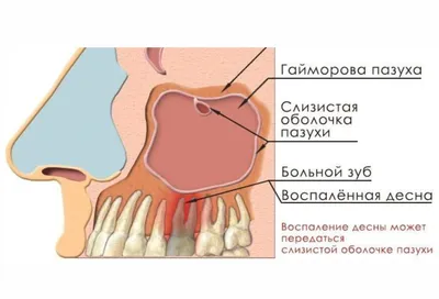 МЦ — ЛЕЧЕНИЕ ОДОНТОГЕННОГО ГАЙМОРИТА В МЕДИЦИНСКОМ ЦЕНТРЕ ЭВВИВА