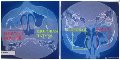 Можно ли при помощи КТ зубов определить гайморит? - Диагностический кабинет  3D KT+