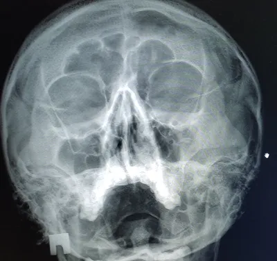 Рентгенография придаточных пазух носа