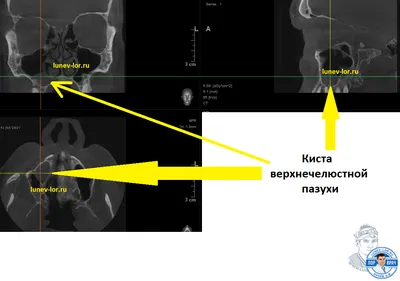 Катаральный гайморит: признаки, симптомы, причины, осложнения, лечение