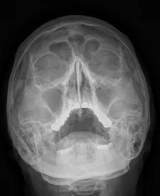 Рентгенография придаточных пазух носа - «Мой первый гайморит: причины,  ренгтен, расшифровка рентгена, лечение» | отзывы