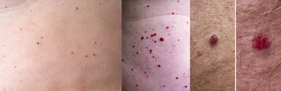 Кровавая роса\" - гемангиомы кожи | Пикабу