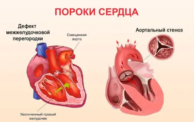 Болезни сердца при болезни соединительной ткани - Центр физической  реабилитации и спортивной медицины EzraMed Clinic
