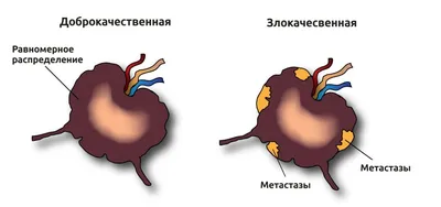 Распространнение рака по лимфатической системе: метастазы в лимфоузлах,  определение стадии рака