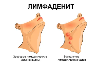 Увеличенные подмышечные лимфоузлы – диагностика причин, лечение в клинике в  Москве