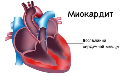 Декстрокардия: жизнь людей, у которых сердце расположено справа |  Федеральный центр НМО | Дзен