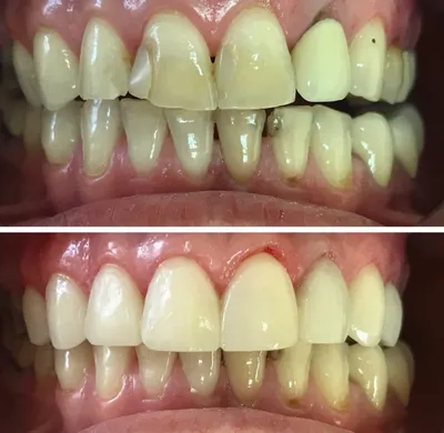 Покрытие зубов композитными материалами | клиника Aesthetica