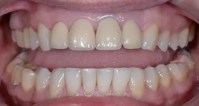 Купить 5D гелевые полоски для отбеливания зубов, белый зубной набор для  ухода за полостью рта, полоски для ухода за полостью рта, виниры для  стоматолога, отбеливание зубов | Joom