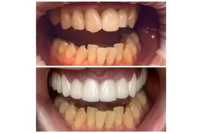Зубные виниры | реставрация зубов | стоматология Sky Dream Clinic