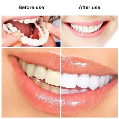 Услуги | Покрытие зубов APF-гелем