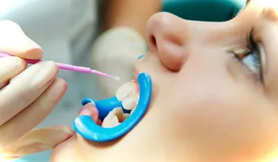 Купить Полоски для отбеливания зубов, 28 шт., профессиональные средства для  отбеливания зубов, гелевые полоски | Joom