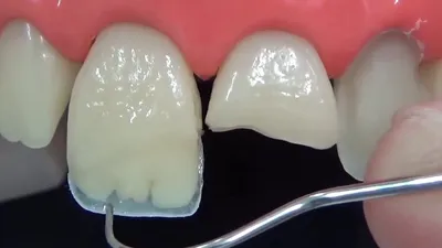 Зубные виниры | реставрация зубов | стоматология Sky Dream Clinic