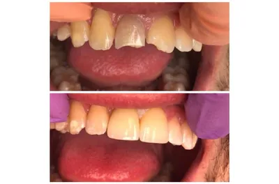 Многоразовые зубные виниры, зубы с красивой улыбкой и удобной посадкой,  временные зубы для пропущенных зубов | AliExpress