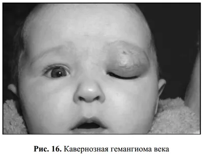 Гемангиома глаза: что собой представляет заболевание, как лечится -  Офтальмологические клиники «Эксимер» (Киев) – диагностика и лечение  заболеваний глаз у взрослых и детей