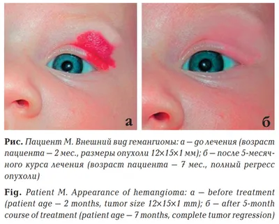 Удаление гемангиомы криотерапией (жидким азотом) - «Две жизни-две судьбы,  гемангиома у новорожденной. Последствия спустя 30 лет и методы удаления. »  | отзывы