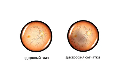 Лазерное удаление гемангиомы » Салон лазерной косметологии \"ЛИЛУ\"