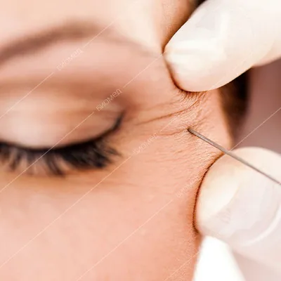 Отзыв о Капли Santen Офтан Тимолол | Глазные Капли офтан тимолол от  глаукомы и от гемангиомы помогают отлично