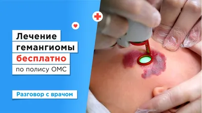 Лечение гемангиомы (ангиомы) в Киеве — Derma.ua
