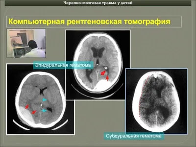 Гематома на лице: как избавиться от гематомы в домашних условиях