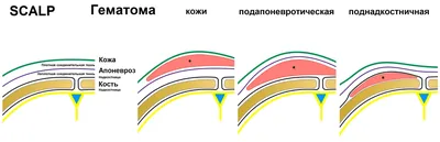 Черепно-мозговая травма