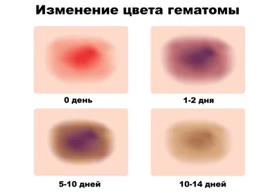 Диагностика посттравматических изменений молочных желез с использо