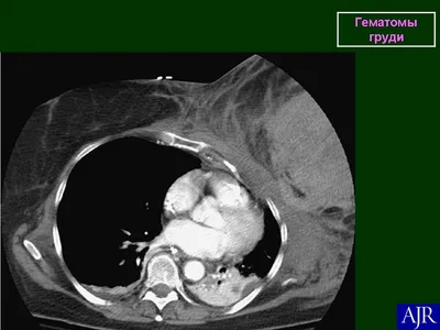 Молочная железа. Гематома. Послеоперационный \"шрам\". + | Портал радиологов