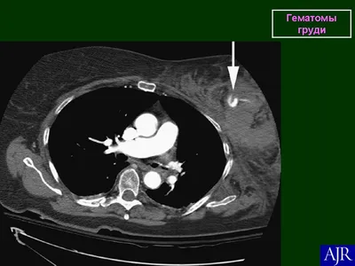 Молочная железа. Гематома. Послеоперационный \"шрам\". + | Портал радиологов