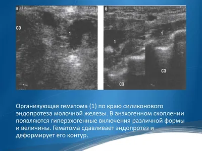 Анимационная деформация молочных желёз после маммопластики (увеличения  груди) | Александр Маркушин пластический хирург