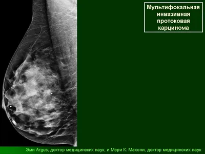 BI-RADS — исследование молочных желез — 24Radiology.ru