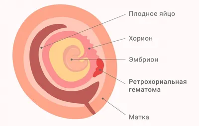 Гематома молочной железы, диагностика и лечение в Сургуте | МЦ Докторплюс