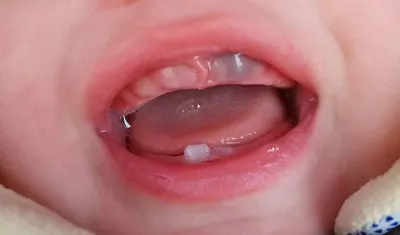 Что нужно знать когда у ребенка режутся зубки? — Стоматологическая клиника  «Улыбка»