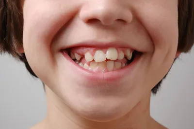 Прорезывания зубов у детей, последовательность, сроки, симптомы