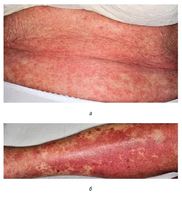Skin manifestations of a new coronovirus infection COVID-19 caused by  SARS-CoV-2 - Khryanin - Vestnik dermatologii i venerologii