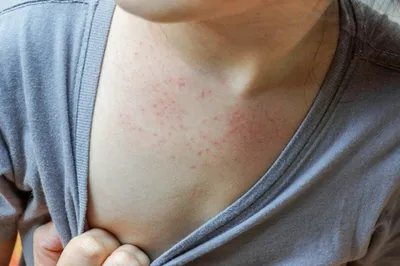 Лечение дерматита в Киеве — Derma.ua