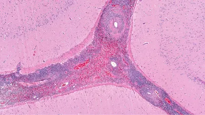 Skin manifestations of a new coronovirus infection COVID-19 caused by  SARS-CoV-2 - Khryanin - Vestnik dermatologii i venerologii