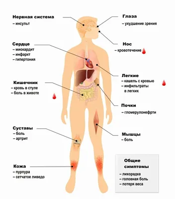 Васкулиты системные - причины появления, симптомы заболевания, диагностика  и способы лечения