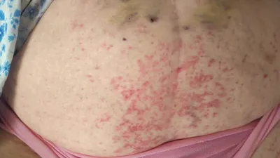 Геморрагическая сыпь на коже — причины, симптомы, как выглядит, формы
