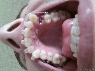 Странное образование после удаления зуба в лунке - Детская стоматология -  Стоматология для всех