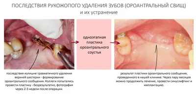 Что стоматолог кладет в лунку после удаления зуба | Рустем Галиуллин | Дзен