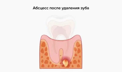 Простое удаление зуба за 10 шагов — CLINICIN.RU