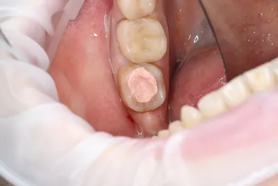 Гемостатическая губка после удаления зуба - Стоматология⚡ VDS  стоматологический магазин