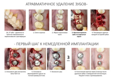 Гемостатическая губка в лунке зуба - Вопрос стоматологу - 03 Онлайн