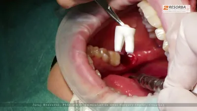 Удаление коренных зубов: виды удаления, как проводится процедура