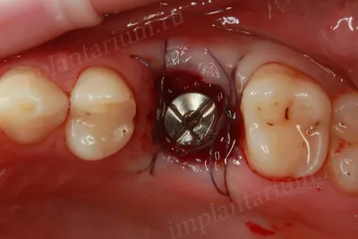 Немедленная имплантация в области многокорневых зубов | Имплантариум  Немедленная имплантация в области многокорневых зубов