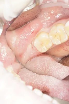 Осложнения после удаления зуба: в лунке что-то белое, кровоточит рана,  болит десна, на десне образовался нарост, опухла щека – Стоматология в  Бирюлево