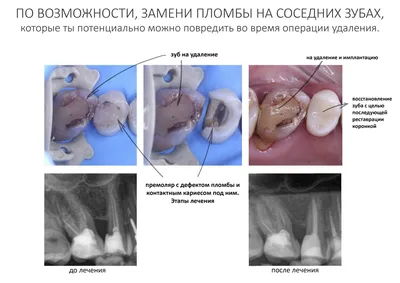 Губка гемостатическая с фурациллином и борной кислотой. 5 см * 5 см * 7 мм.